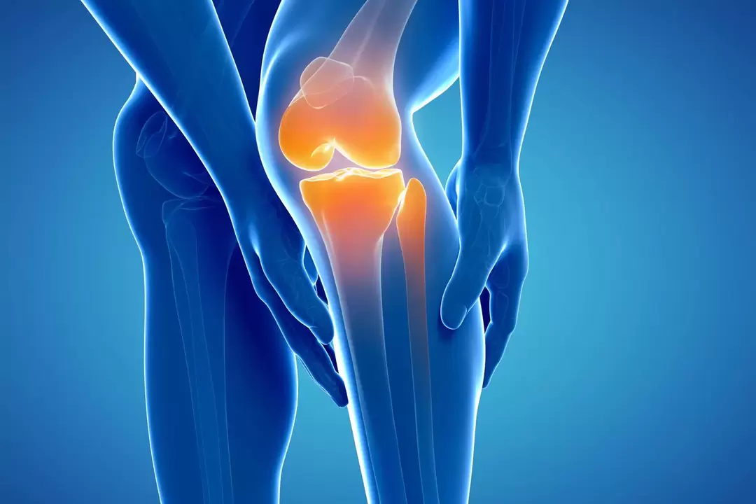Artróza kolenného kĺbu (gonartróza, deformujúca sa osteoartróza)