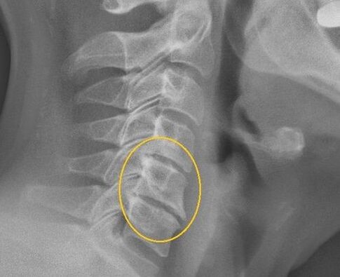 Osteochondróza krčnej chrbtice na x -roy