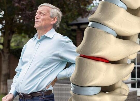 Osteochondróza postihuje medzistavcové platničky a spôsobuje bolesti chrbta